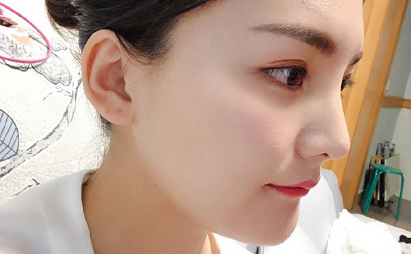 石家莊藍(lán)山杜建龍醫(yī)生下頜角整容手術(shù)案例一年