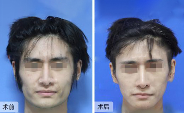 做下頜角整形風(fēng)險(xiǎn)有哪些？