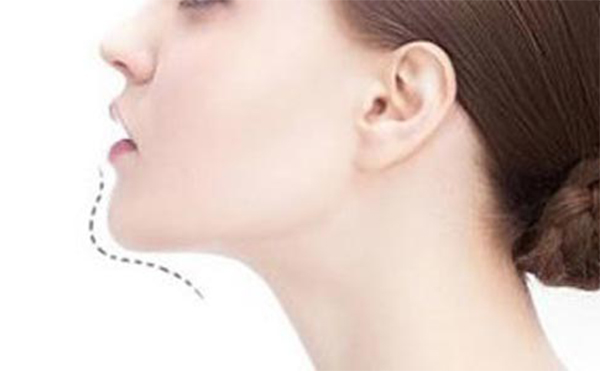 玻尿酸豐下巴好嗎？做玻尿酸豐下巴需要注意什么