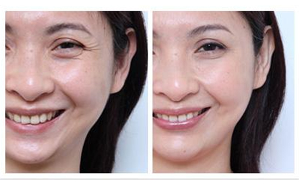 去魚尾紋多少錢？