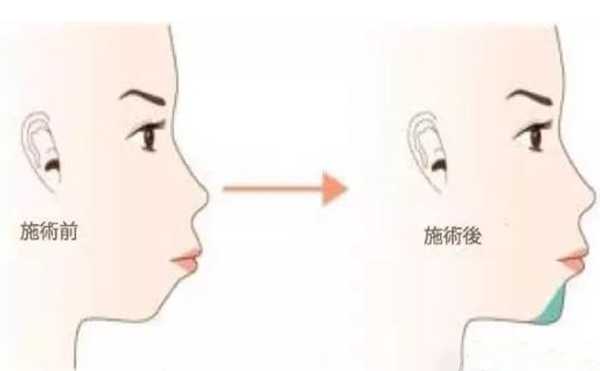 注射愛(ài)貝芙墊下巴多少錢(qián)?有什么特點(diǎn)?