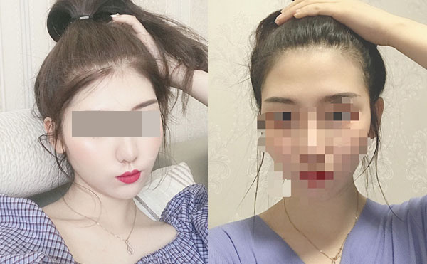 冰點(diǎn)脫毛后多久可以洗澡嗎？