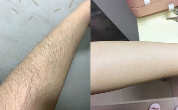 光子手臂脫毛是怎么做的？
