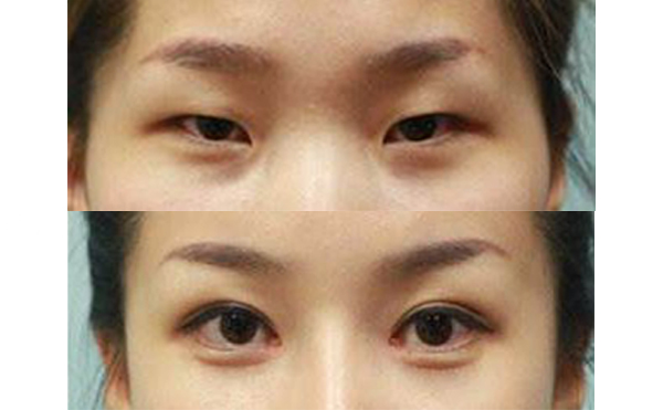 眼綜合手術(shù)多久能恢復(fù)自然？