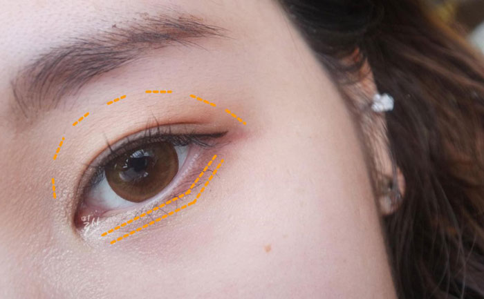 眼窩自體脂肪填充多少錢？自體脂肪豐眼窩成活率高嗎？