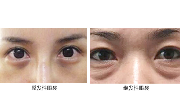 去眼袋手術(shù)能保持多久?如何避免復(fù)發(fā)?