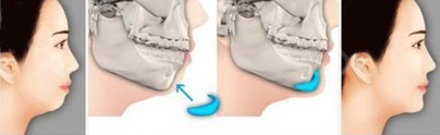 假體下巴手術(shù)圖