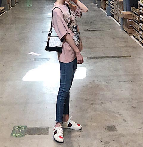 大腿吸脂術后效果反饋