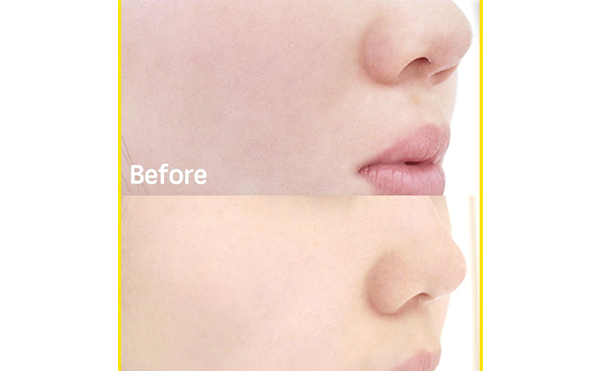 無針水光針有副作用嗎？