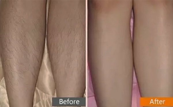 彩光脫毛是什么原理?有什么特點?