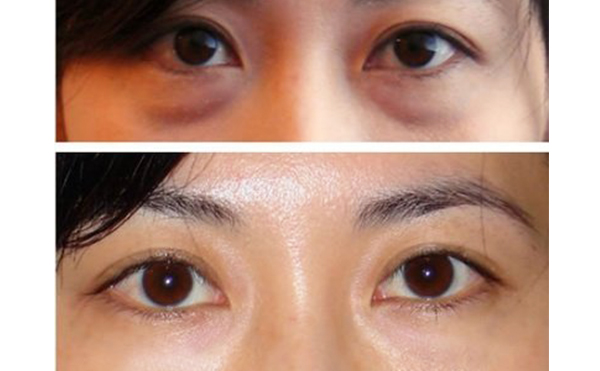 眼袋抽脂的手術過程是什么？