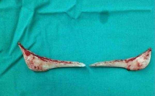 下頜角整形口內(nèi)切口和口外切口哪種方式更好？