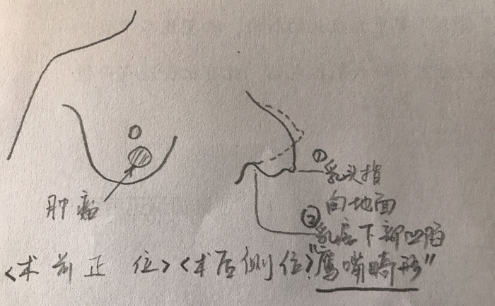 乳房畸形是什么原因造成的？乳房畸形矯正手術(shù)方法？