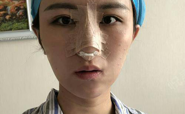 隆鼻怎么檢查失敗?根據(jù)失敗情況應(yīng)該怎么處理?