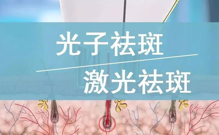 光子祛斑效果如何？