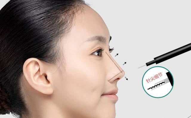 鼻部除皺的最好方法是什么？鼻部除皺多少錢？