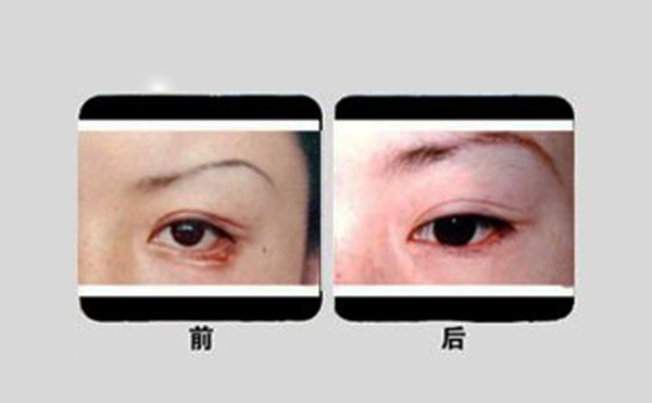 眼瞼外翻手術(shù)步驟是什么?有什么優(yōu)勢?