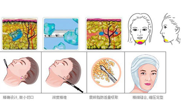 下巴整形吸脂術(shù)要多少錢？