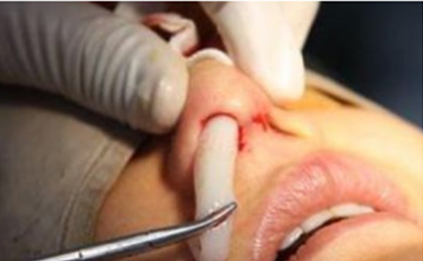 假體隆鼻術(shù)后為什么會發(fā)生假體移動的情況?如何避免這類情況的發(fā)生