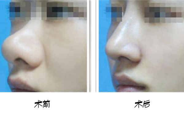 武漢美亞鼻頭肥大矯正術(shù)多少錢?網(wǎng)上查到的和醫(yī)院報(bào)價(jià)一樣嗎?