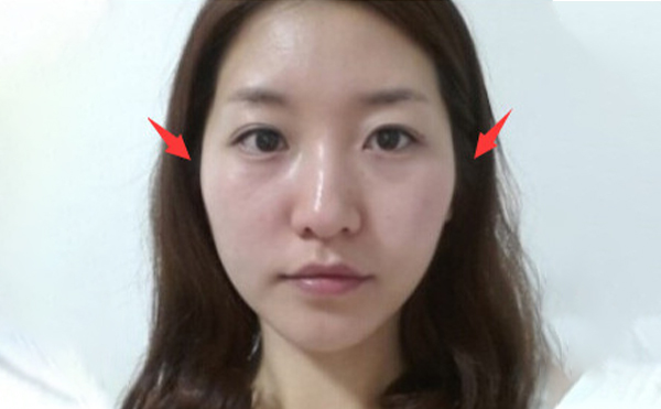 蘭州亞韓整形：顴骨突出做顴骨降低整形手術就對了