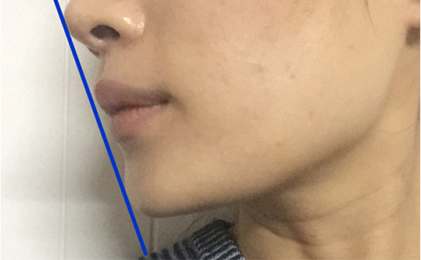 做假體墊下巴恢復(fù)后會(huì)被摸出來(lái)做過(guò)嗎？還能打玻尿酸嗎？