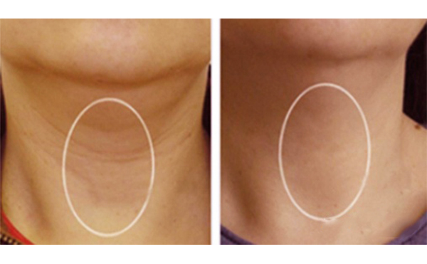 嗨體去頸紋能維持多久？