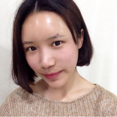 全臉脂肪填充效果對比圖3