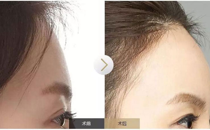 額頭填充術(shù)可以保持多久？