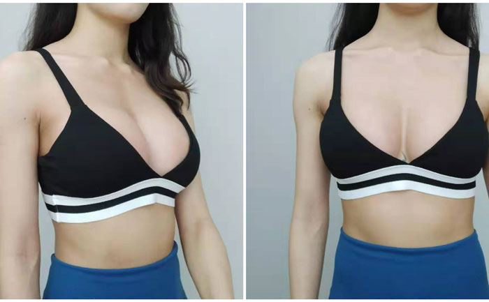 自體豐胸可以保持多久？自體脂肪豐胸真實(shí)效果