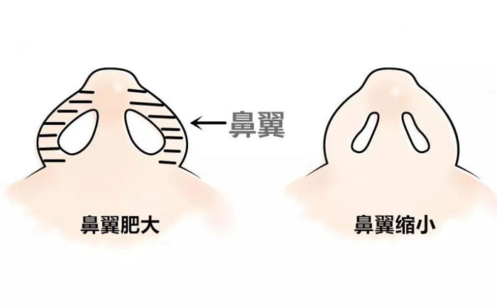 鼻翼縮小手術(shù)要做多久？