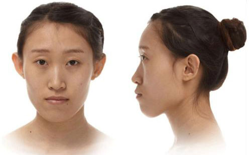 下巴突出是什么原因引起的？下巴突出側面很難看怎么矯正？