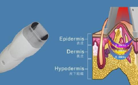 射頻除皺的效果好嗎？