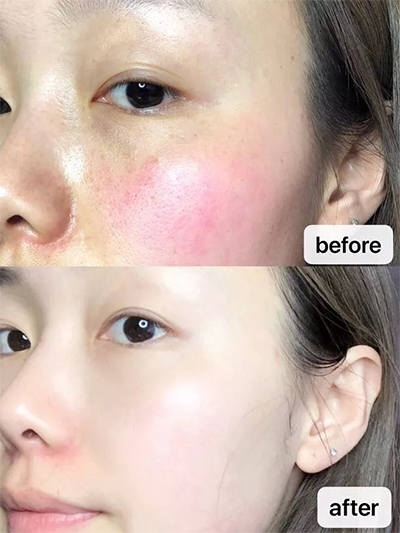 九江協(xié)和光子嫩膚--素顏也扛打的秘密