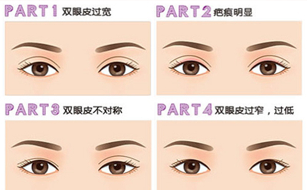 雙眼皮手術(shù)失敗如何修復(fù)呢?需要多長時間?