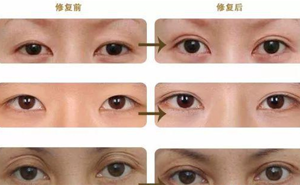 雙眼皮修復(fù)可靠嗎？什么時(shí)候做雙眼皮修復(fù)比較好？