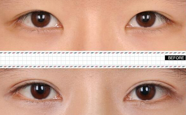 內(nèi)雙怎么才能變成雙眼皮?效果好嗎?