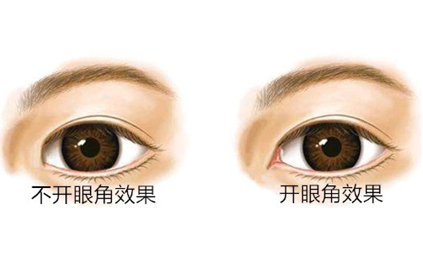 開內(nèi)眼角價(jià)格是多少?開內(nèi)眼角多久能恢復(fù)好?