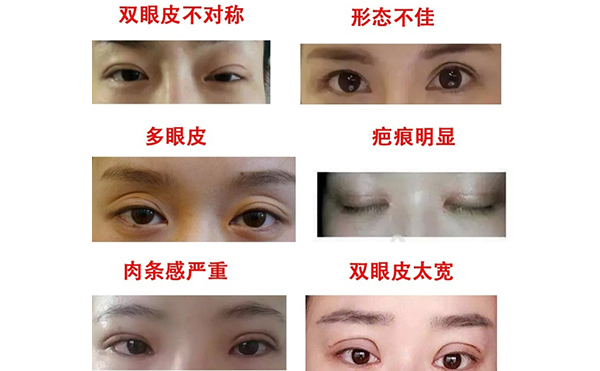 哪些情況需做雙眼皮修復(fù)？修復(fù)難度大不大?