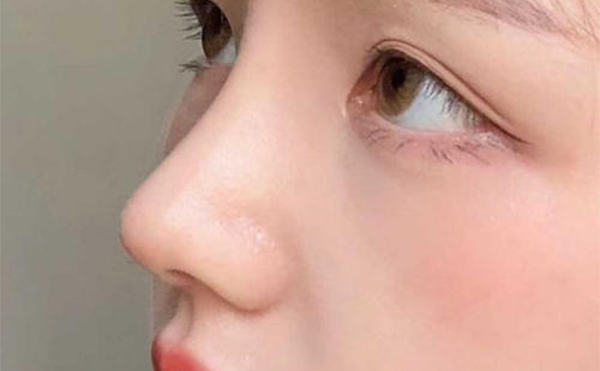 鼻假體取出術(shù)容易嗎?