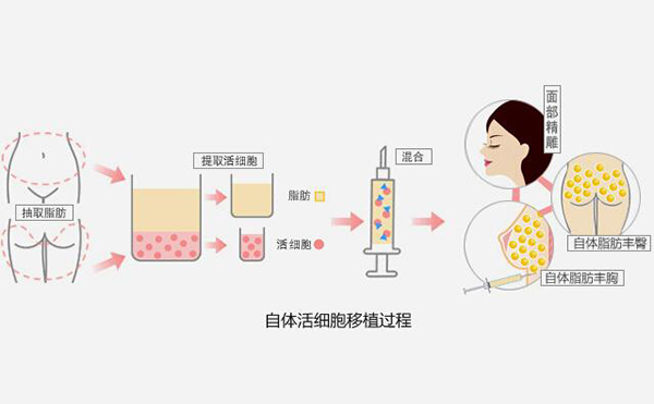 填充臀部有哪些方法?疤痕體質可以做豐臀嗎?