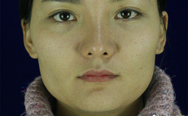 石家莊藍(lán)山杜建龍醫(yī)生下頜角整容手術(shù)案例術(shù)前效果