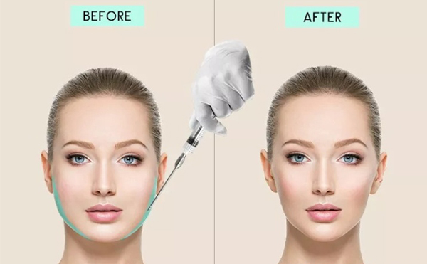 面部吸脂有哪幾種手術(shù)方法？