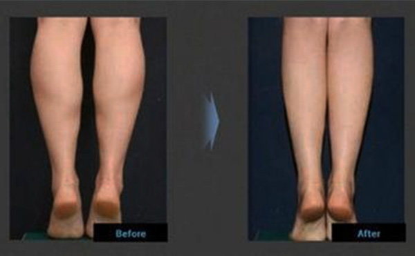 小腿吸脂的原理是什么？