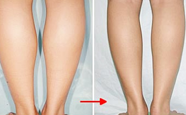腿部吸脂有什么優(yōu)勢?術后會反彈嗎?