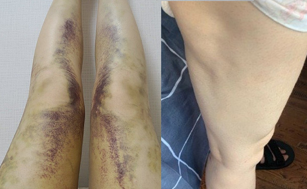 腹部吸脂有什么副作用？