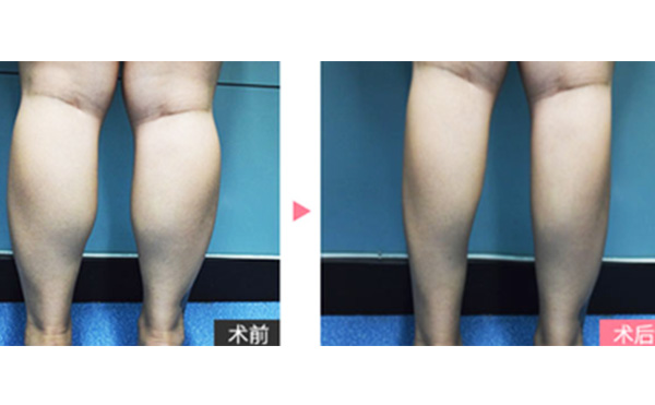 boxo瘦腿有什么優(yōu)勢？