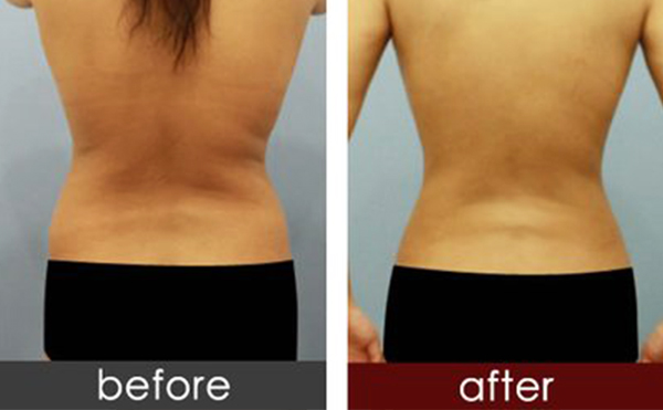 背部吸脂手術(shù)的過程是什么？