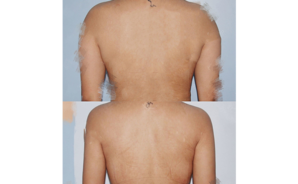 背部吸脂安全嗎？