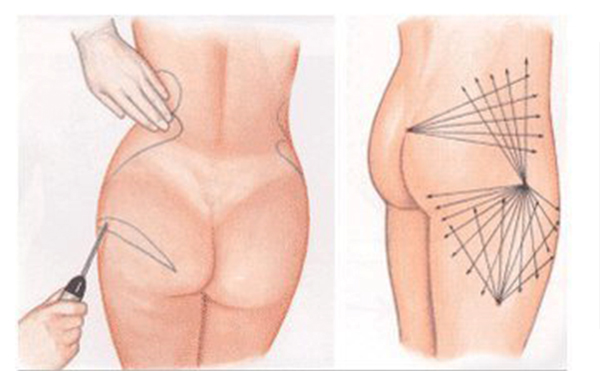 臀部吸脂的手術(shù)過程是什么？